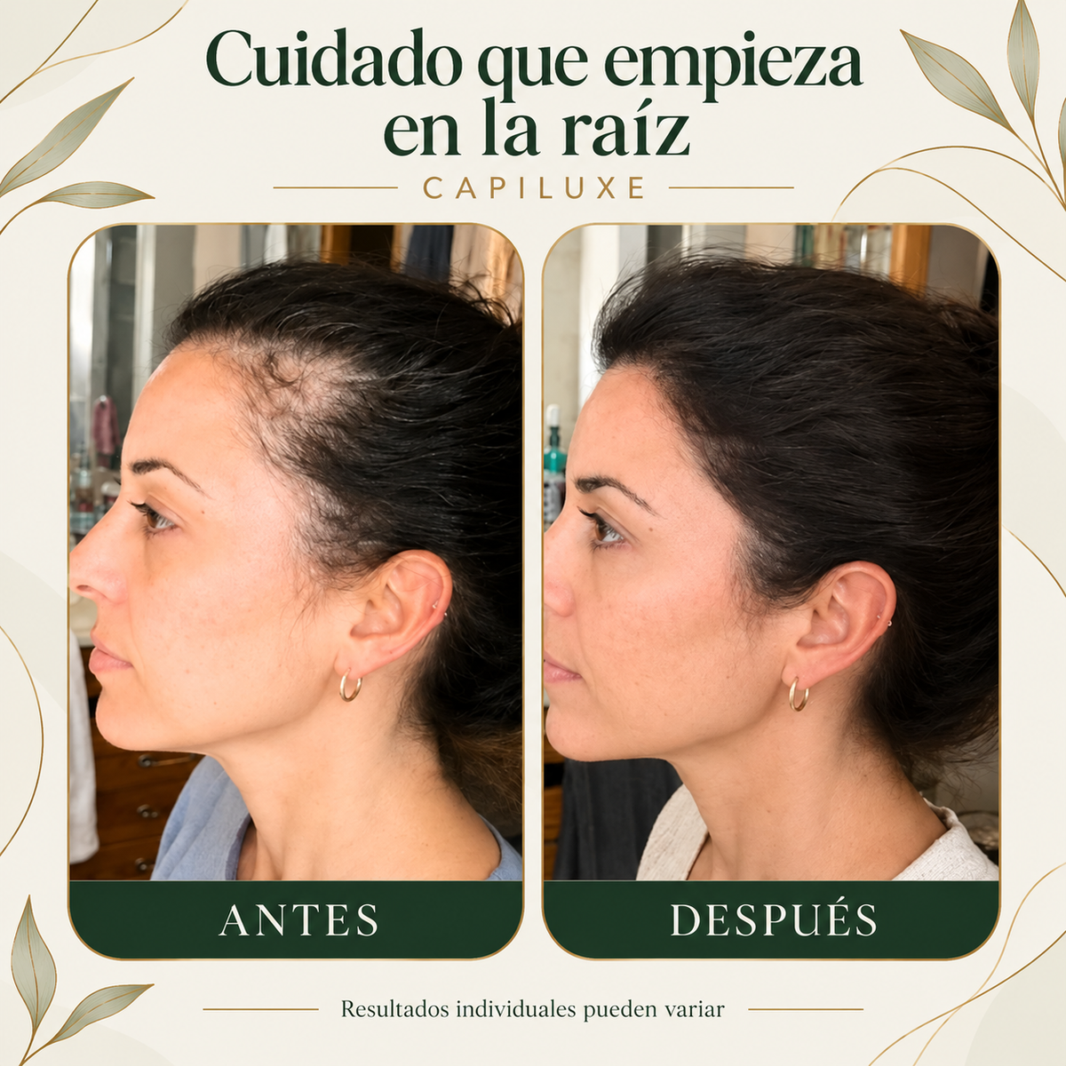Capiluxe: comparativa visual antes y después; resultados individuales pueden variar