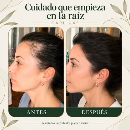 Capiluxe: comparativa visual antes y después; resultados individuales pueden variar